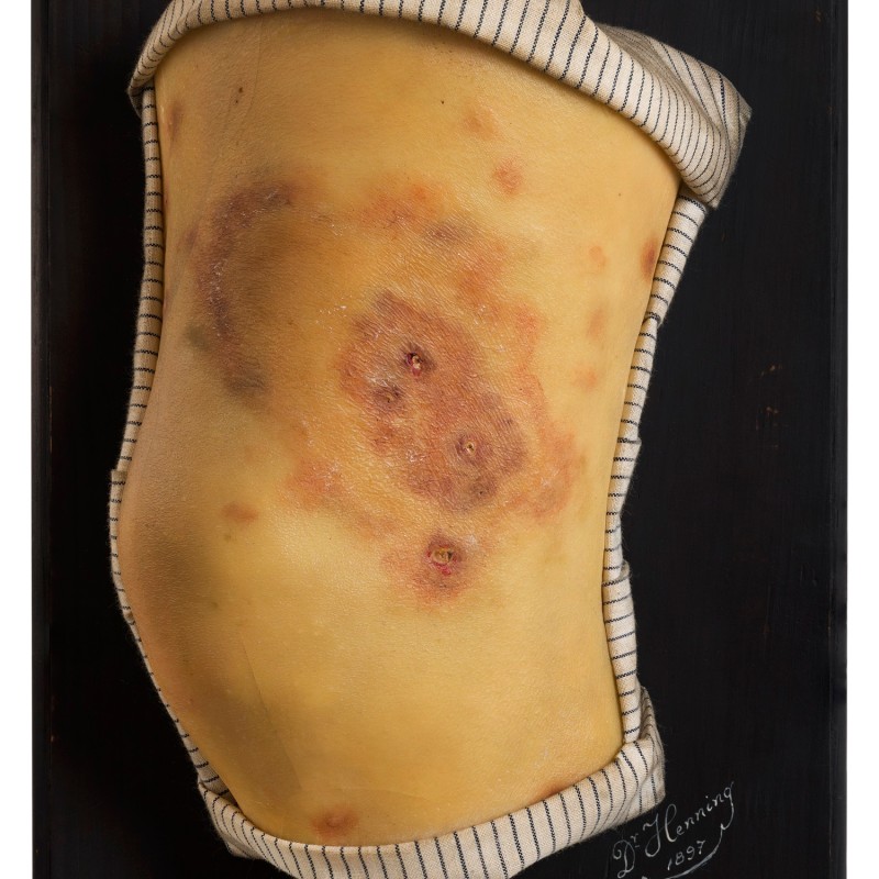 Knie mit Lepra, Tuberkuloide (paucibazilliäre) Lepra © NHM Wien, Reiner Riedler