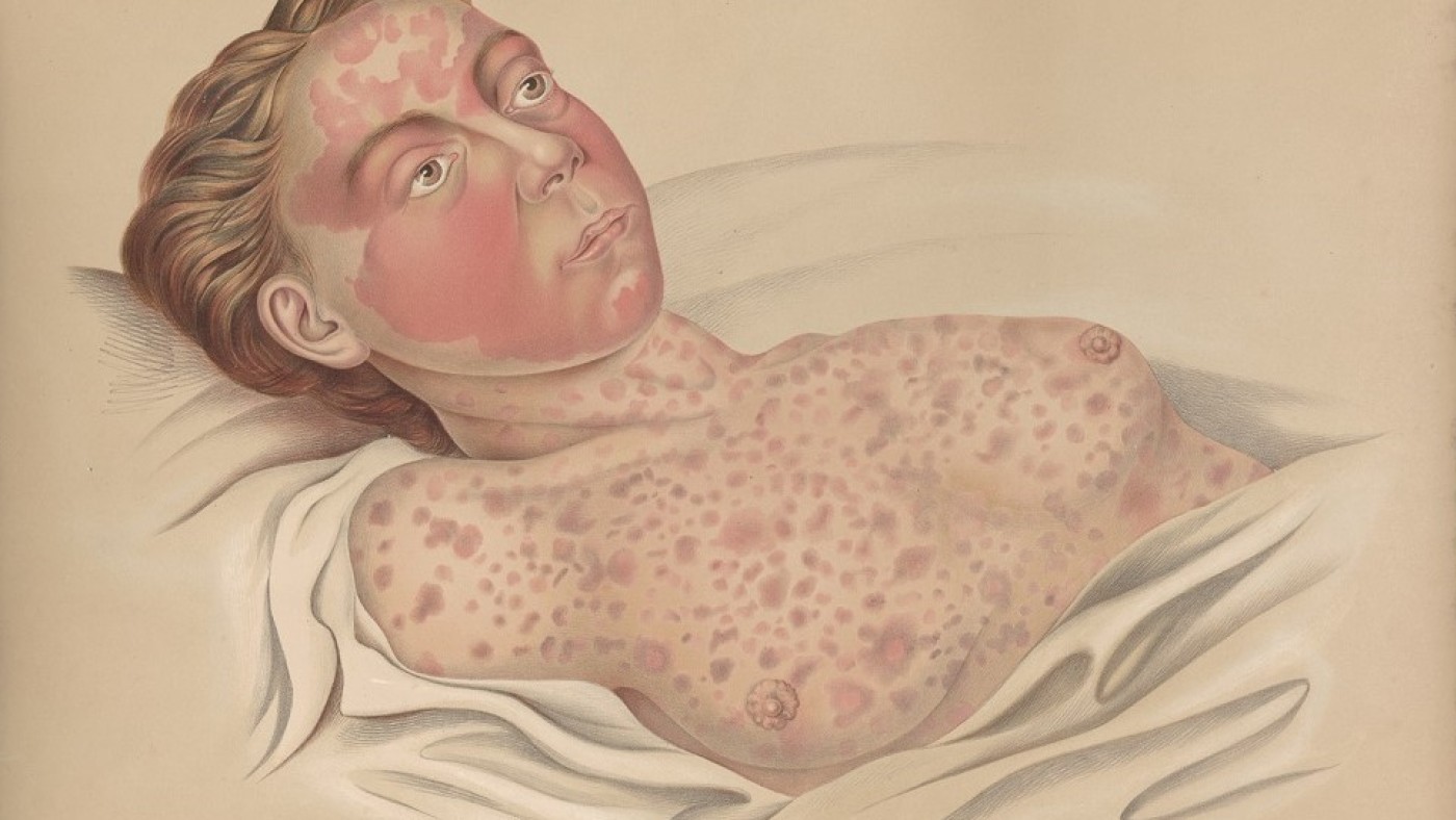 Eine mit Cholera infizierte
Person (Atlas der Hautkrankheiten von Ferdinand von Hebra, 1856) | © Narrenturm Eine mit Cholera infizierte Person
(Atlas der Hautkrankheiten von Ferdinand von Hebra, 1856) | © Narrenturm