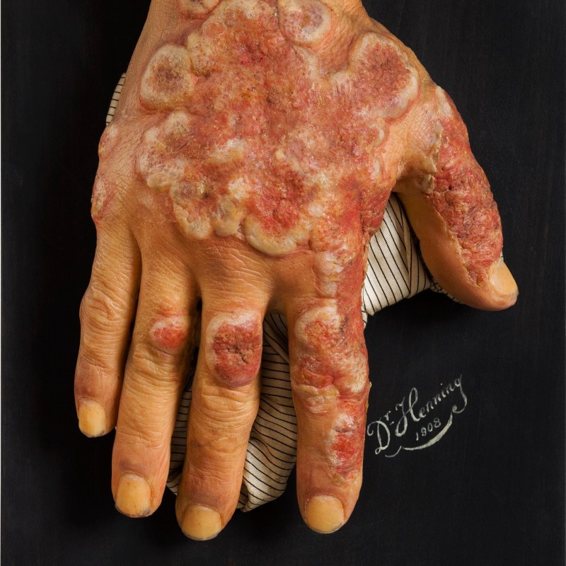 Redness and inflammation of the skin, Erythema multiforme exsudativum (c) NHM Wien, Reiner Riedler