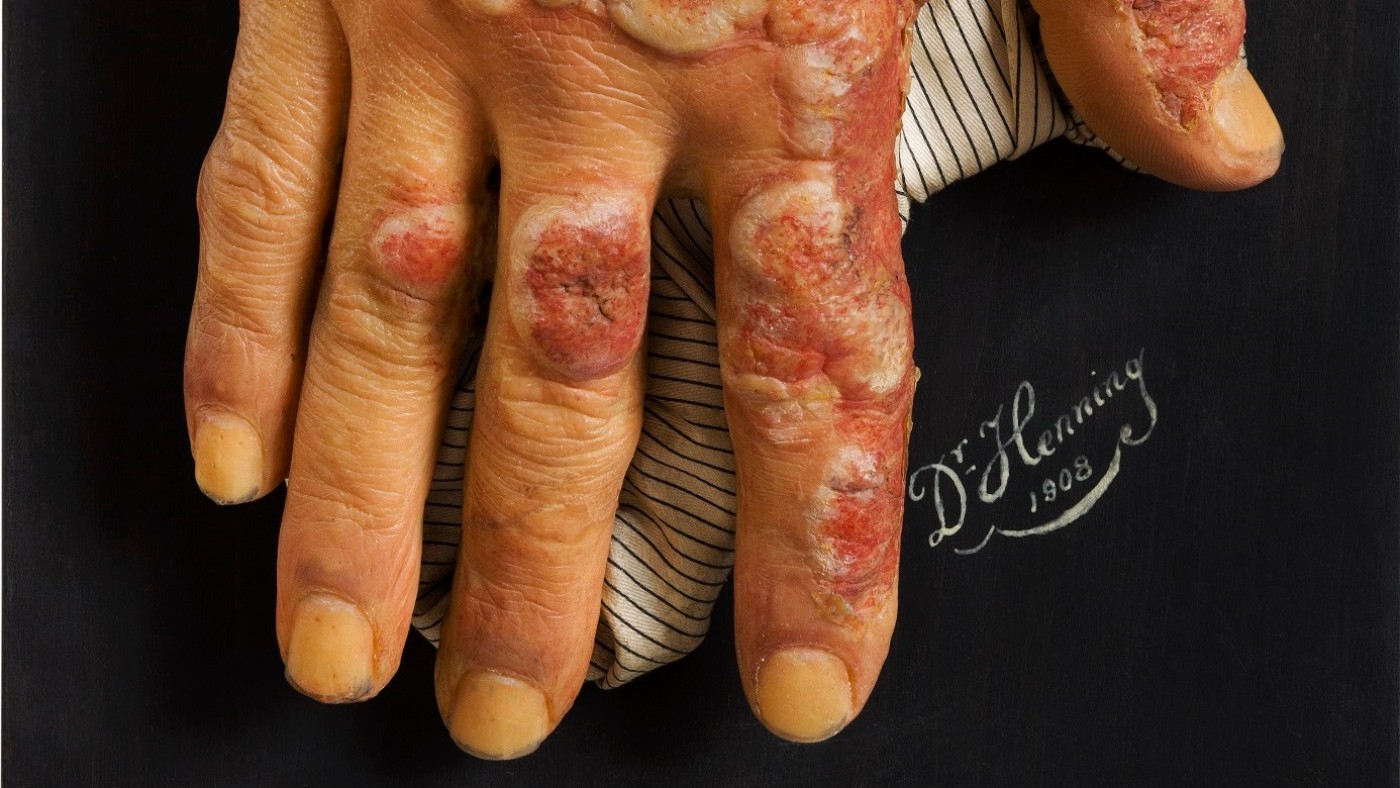 Rötungen und Entzündungen der Haut, Erythema multiforme exsudativum
(c) NHM Wien, Reiner Riedler