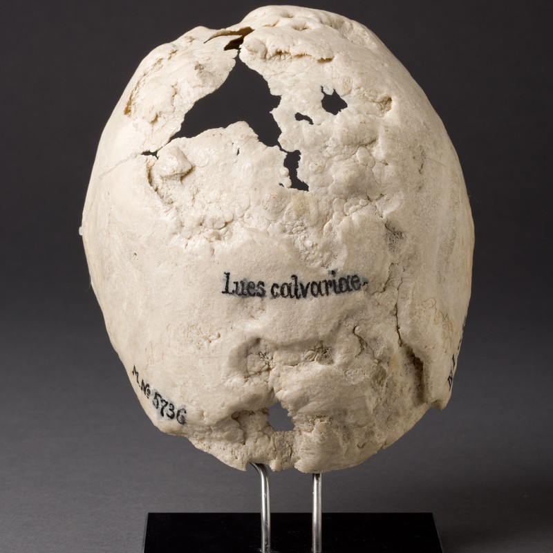 Syphiliserkrankung,
                                 Schädel-Kalotte © NHM Wien, Wolfgang Reichmann