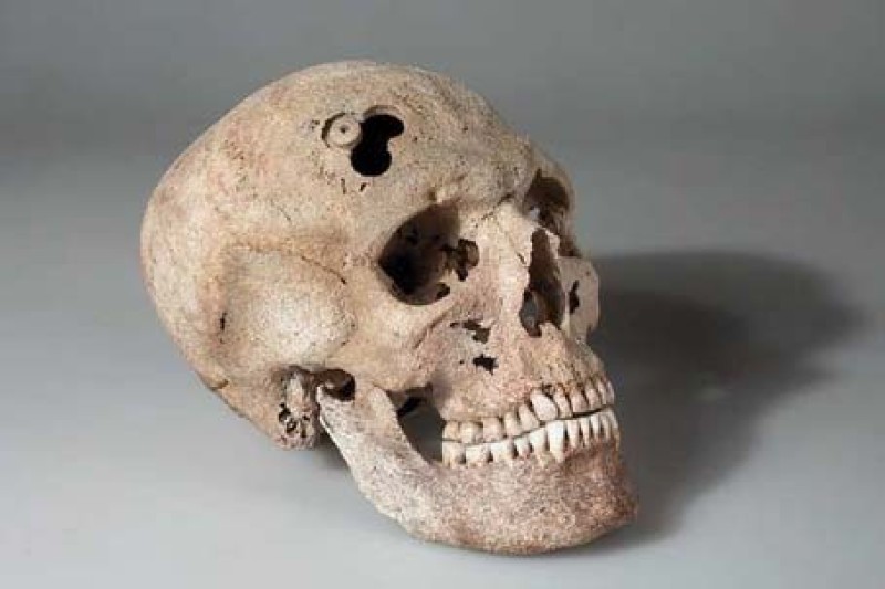 Original Schädel aus Katzelsdorf mit unvollendeter Dreifachtrepanation